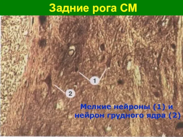 Задние рога СМ Мелкие нейроны (1) и нейрон грудного ядра (2)