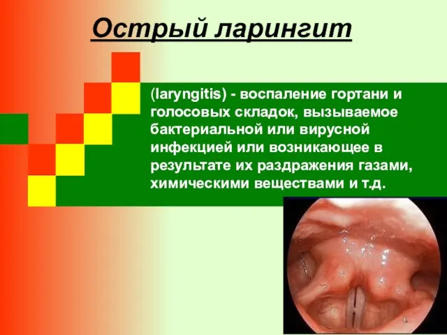 Острый ларингит (laryngitis) - воспаление гортани и голосовых складок, вызываемое бактериальной