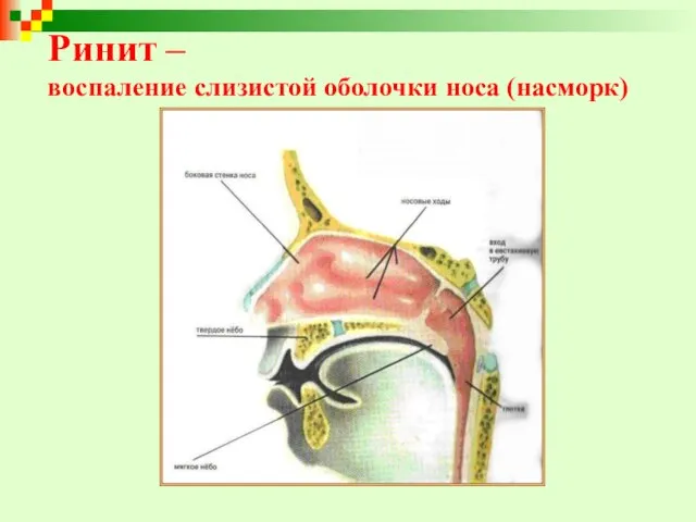 Ринит – воспаление слизистой оболочки носа (насморк)