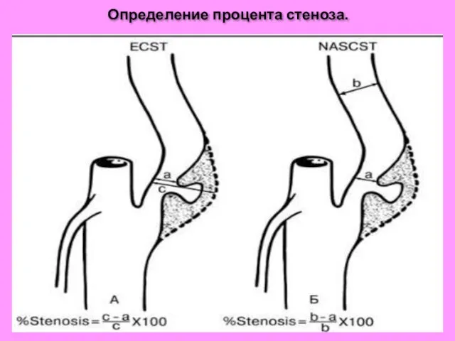 Определение процента стеноза.