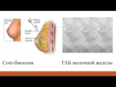 Core-биопсия ТАБ молочной железы