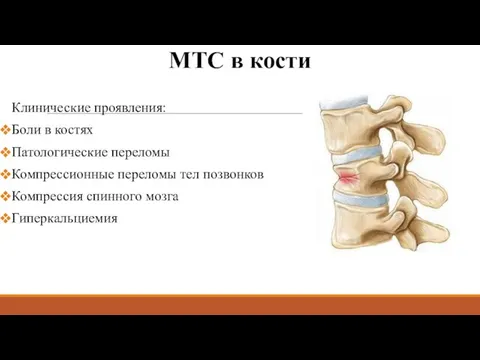 МТС в кости Клинические проявления: Боли в костях Патологические переломы Компрессионные