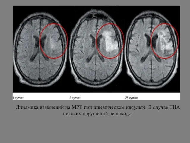 Динамика изменений на МРТ при ишемическом инсульте. В случае ТИА никаких нарушений не находят