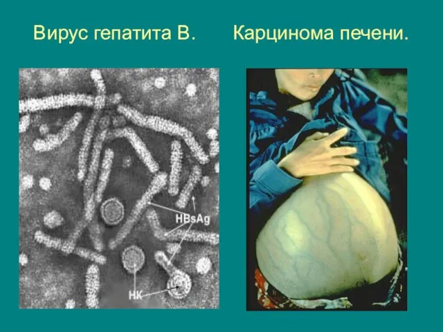Вирус гепатита В. Карцинома печени.