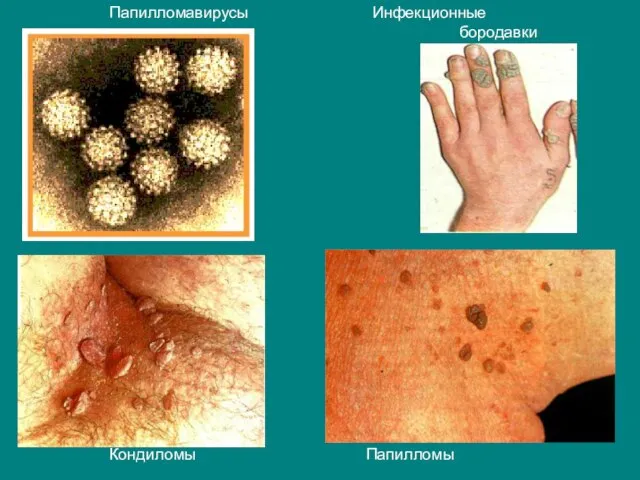 Папилломавирусы Инфекционные бородавки Кондиломы Папилломы