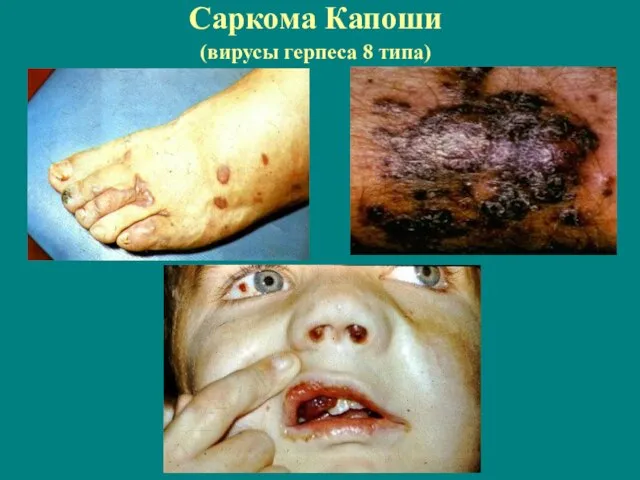 Саркома Капоши (вирусы герпеса 8 типа)