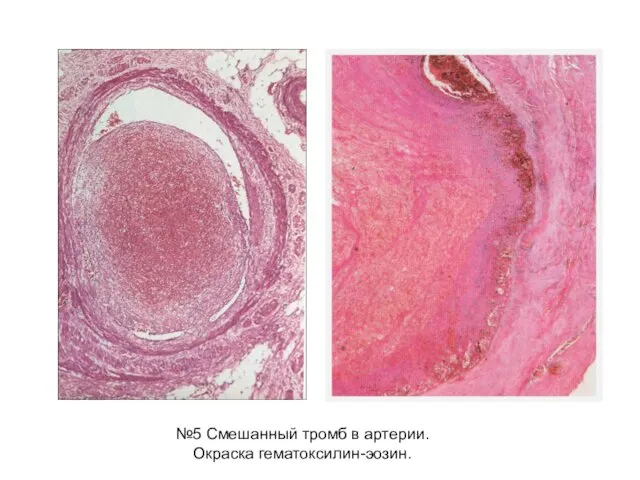 №5 Смешанный тромб в артерии. Окраска гематоксилин-эозин.