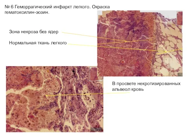 № 6 Геморрагический инфаркт легкого. Окраска гематоксилин-эозин. Зона некроза без ядер