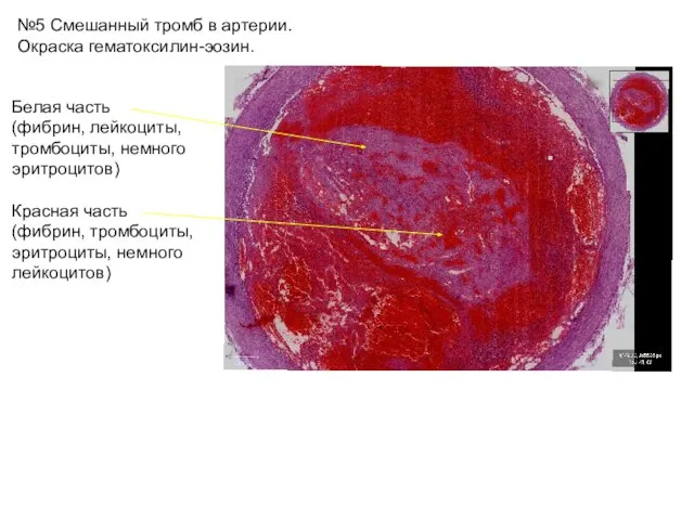 №5 Смешанный тромб в артерии. Окраска гематоксилин-эозин. Белая часть (фибрин, лейкоциты,