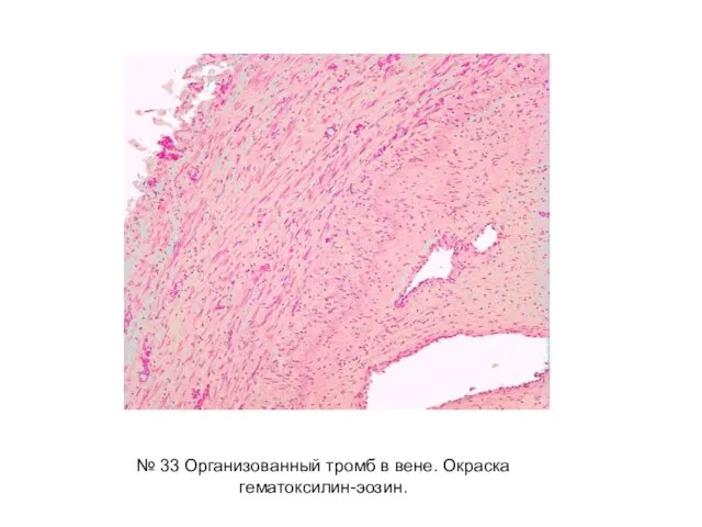 № 33 Организованный тромб в вене. Окраска гематоксилин-эозин.