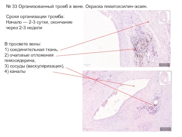 № 33 Организованный тромб в вене. Окраска гематоксилин-эозин. Сроки организации тромба:
