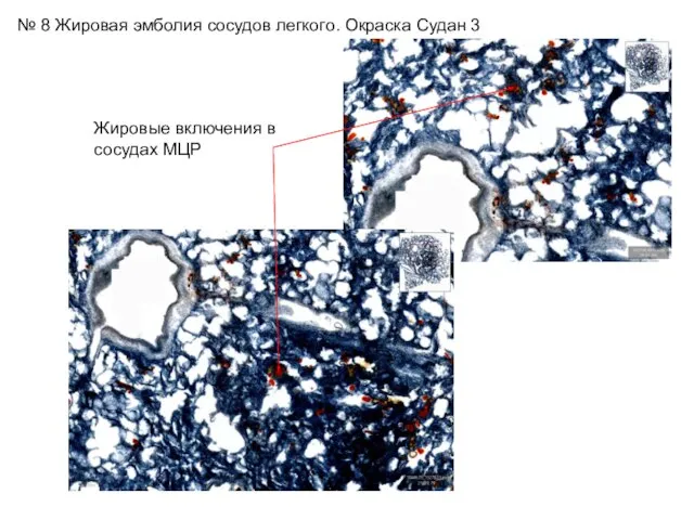 № 8 Жировая эмболия сосудов легкого. Окраска Судан 3 Жировые включения в сосудах МЦР