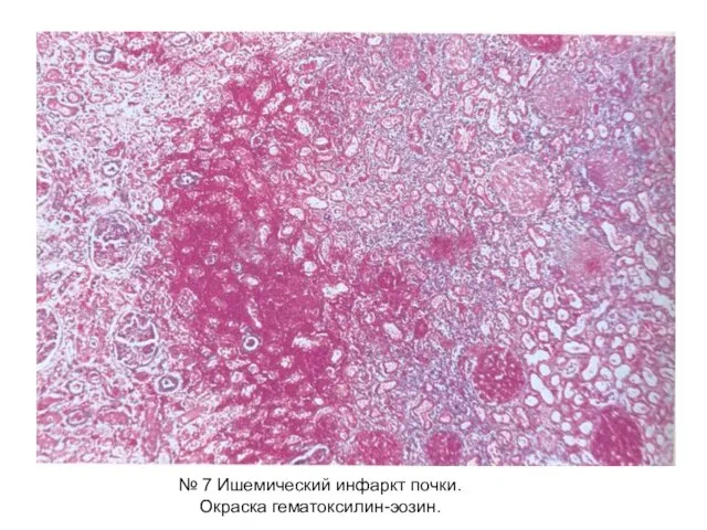 № 7 Ишемический инфаркт почки. Окраска гематоксилин-эозин.