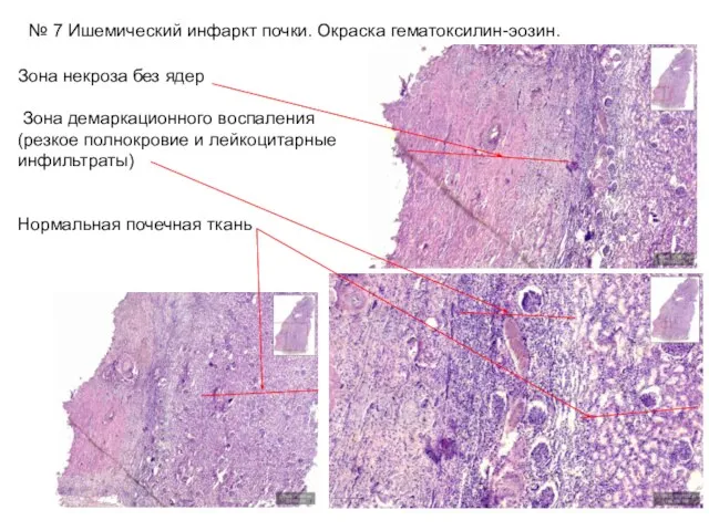 № 7 Ишемический инфаркт почки. Окраска гематоксилин-эозин. Зона некроза без ядер