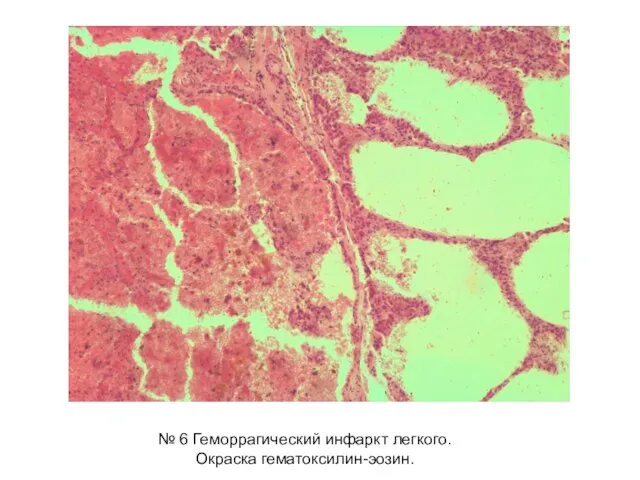 № 6 Геморрагический инфаркт легкого. Окраска гематоксилин-эозин.