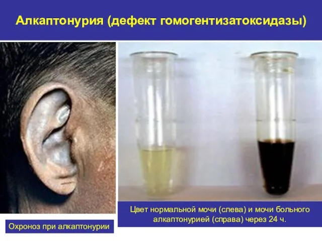 Алкаптонурия (дефект гомогентизатоксидазы) Охроноз при алкаптонурии Цвет нормальной мочи (слева) и