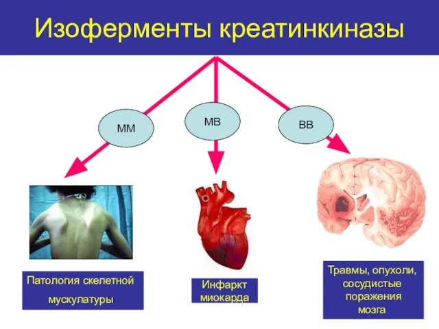 Изоферменты креатинкиназы Инфаркт миокарда Патология скелетной мускулатуры Травмы, опухоли, сосудистые поражения мозга ММ МВ ВВ