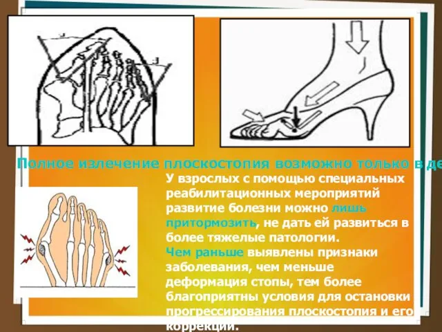 Полное излечение плоскостопия возможно только в детстве. У взрослых с помощью