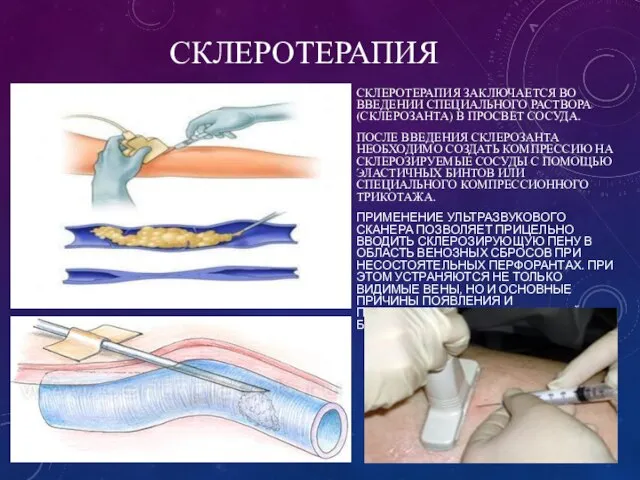 СКЛЕРОТЕРАПИЯ СКЛЕРОТЕРАПИЯ ЗАКЛЮЧАЕТСЯ ВО ВВЕДЕНИИ СПЕЦИАЛЬНОГО РАСТВОРА (СКЛЕРОЗАНТА) В ПРОСВЕТ СОСУДА.