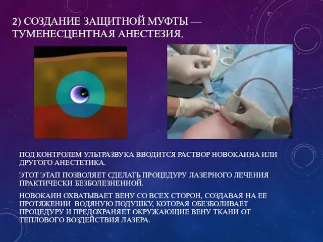 2) СОЗДАНИЕ ЗАЩИТНОЙ МУФТЫ — ТУМЕНЕСЦЕНТНАЯ АНЕСТЕЗИЯ. ПОД КОНТРОЛЕМ УЛЬТРАЗВУКА ВВОДИТСЯ