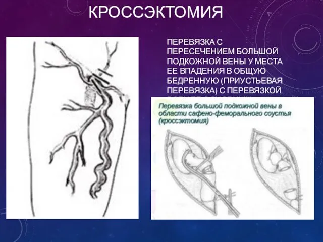 КРОССЭКТОМИЯ ПЕРЕВЯЗКА С ПЕРЕСЕЧЕНИЕМ БОЛЬШОЙ ПОДКОЖНОЙ ВЕНЫ У МЕСТА ЕЕ ВПАДЕНИЯ