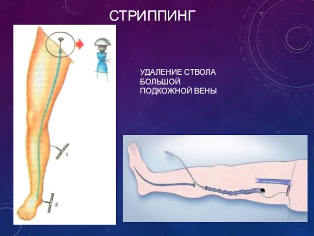 СТРИППИНГ УДАЛЕНИЕ СТВОЛА БОЛЬШОЙ ПОДКОЖНОЙ ВЕНЫ