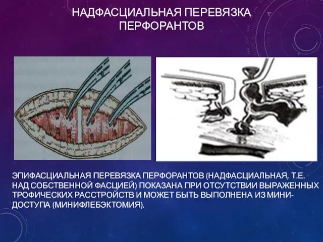 НАДФАСЦИАЛЬНАЯ ПЕРЕВЯЗКА ПЕРФОРАНТОВ ЭПИФАСЦИАЛЬНАЯ ПЕРЕВЯЗКА ПЕРФОРАНТОВ (НАДФАСЦИАЛЬНАЯ, Т.Е. НАД СОБСТВЕННОЙ ФАСЦИЕЙ)