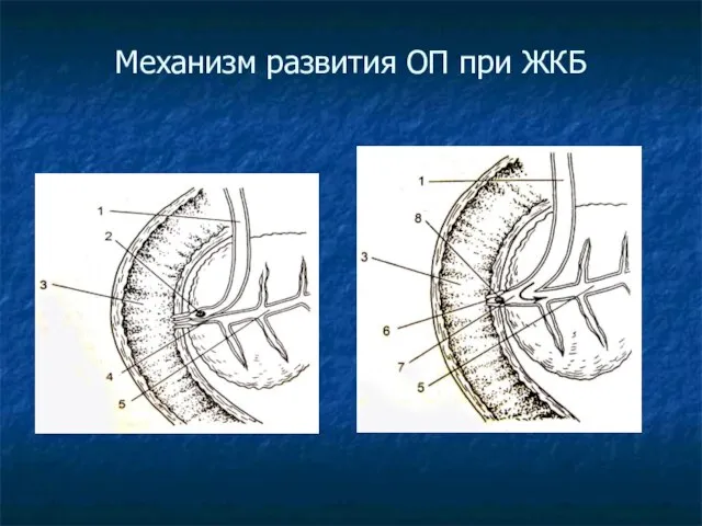 Механизм развития ОП при ЖКБ