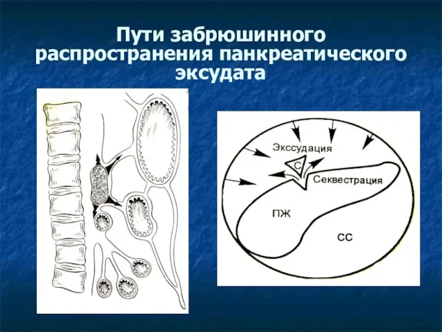 Пути забрюшинного распространения панкреатического эксудата