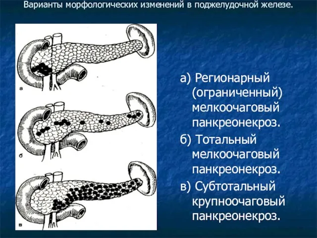 Варианты морфологических изменений в поджелудочной железе. а) Регионарный (ограниченный) мелкоочаговый панкреонекроз.