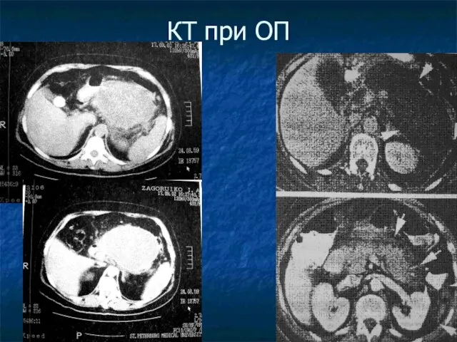 КТ при ОП