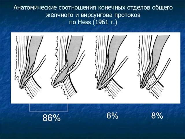 Анатомические соотношения конечных отделов общего желчного и вирсунгова протоков по Hess (1961 г.) 86% 6% 8%