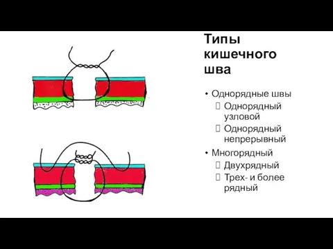 Типы кишечного шва Однорядные швы Однорядный узловой Однорядный непрерывный Многорядный Двухрядный Трех- и более рядный