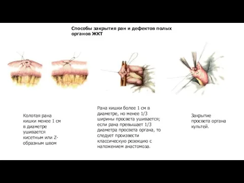 Способы закрытия ран и дефектов полых органов ЖКТ Колотая рана кишки