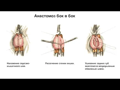 Наложение серозно-мышечного шва. Рассечение стенки кишки. Ушивание задних губ анастомоза непрерывным