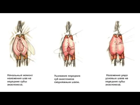 Начальный момент наложения шва на передние губы анастомоза. Ушивание передних губ