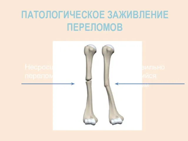 ПАТОЛОГИЧЕСКОЕ ЗАЖИВЛЕНИЕ ПЕРЕЛОМОВ Несросшийся перелом Неправильно сросшийся перелом