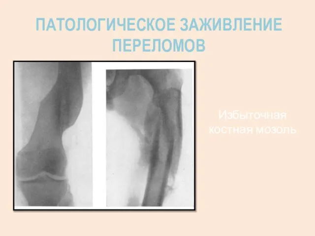 ПАТОЛОГИЧЕСКОЕ ЗАЖИВЛЕНИЕ ПЕРЕЛОМОВ Избыточная костная мозоль