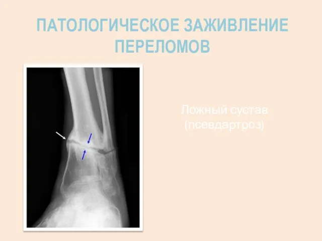 ПАТОЛОГИЧЕСКОЕ ЗАЖИВЛЕНИЕ ПЕРЕЛОМОВ Ложный сустав (псевдартроз)