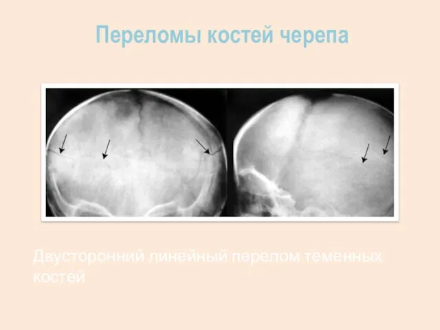 Переломы костей черепа Двусторонний линейный перелом теменных костей