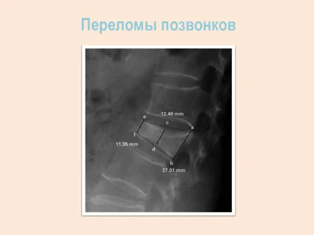 Переломы позвонков