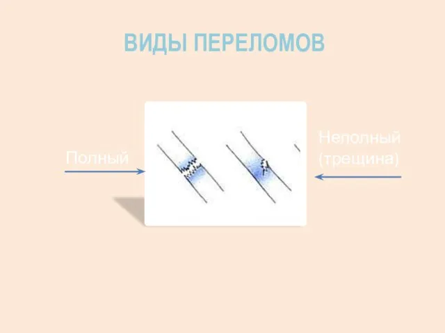 ВИДЫ ПЕРЕЛОМОВ Полный Неполный (трещина)