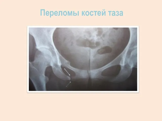 Переломы костей таза