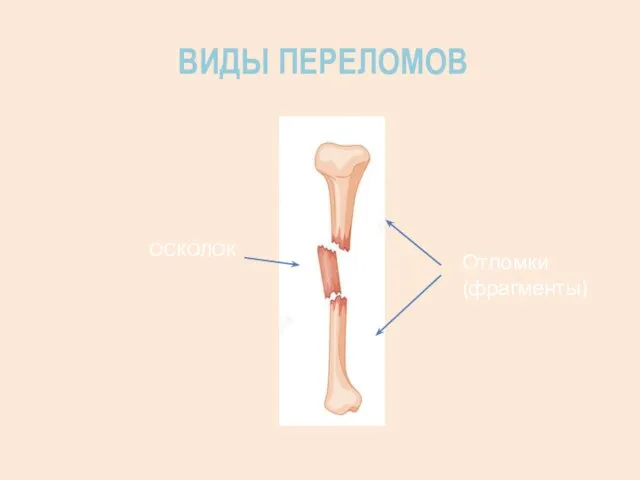 ВИДЫ ПЕРЕЛОМОВ ОСКОЛОК Отломки (фрагменты)