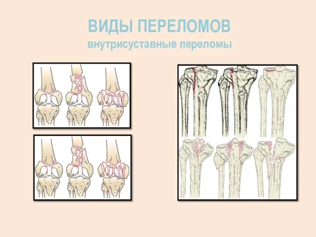 ВИДЫ ПЕРЕЛОМОВ внутрисуставные переломы