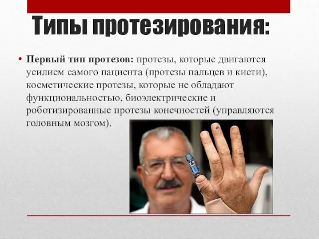 Типы протезирования: Первый тип протезов: протезы, которые двигаются усилием самого пациента