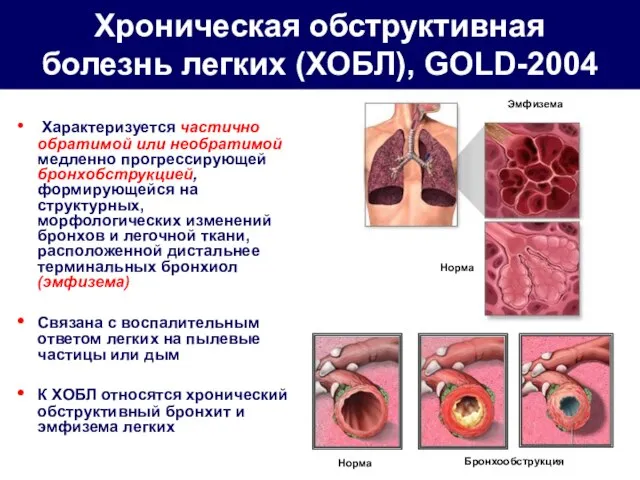 Хроническая обструктивная болезнь легких (ХОБЛ), GOLD-2004 Характеризуется частично обратимой или необратимой
