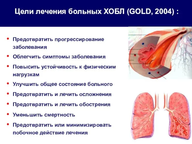 Цели лечения больных ХОБЛ (GOLD, 2004) : Предотвратить прогрессирование заболевания Облегчить