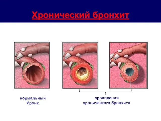 Хронический бронхит