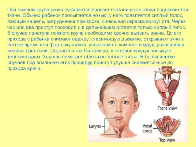 При ложном крупе резко суживается просвет гортани из-за отека подслизистой ткани.